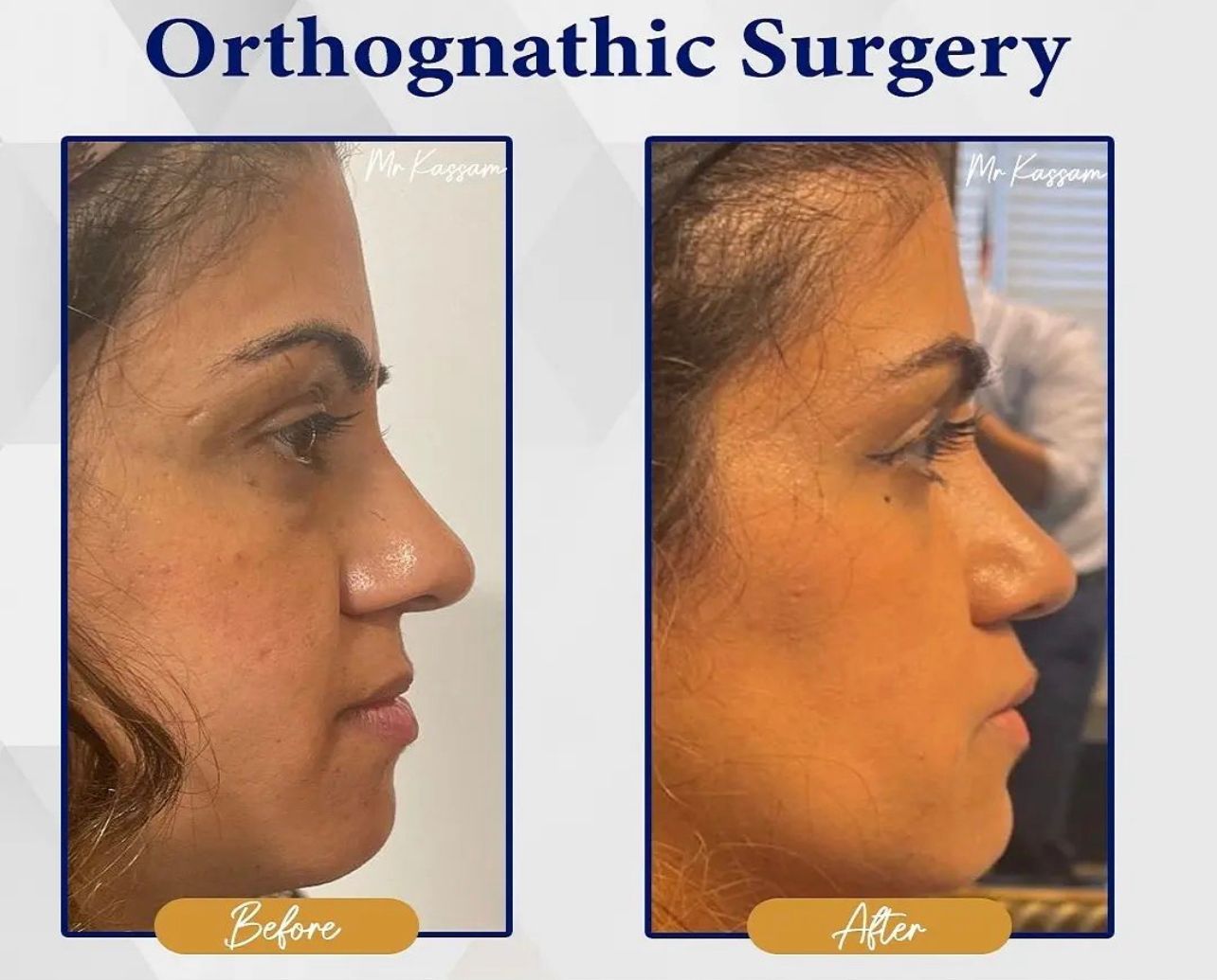 Facial Surgery